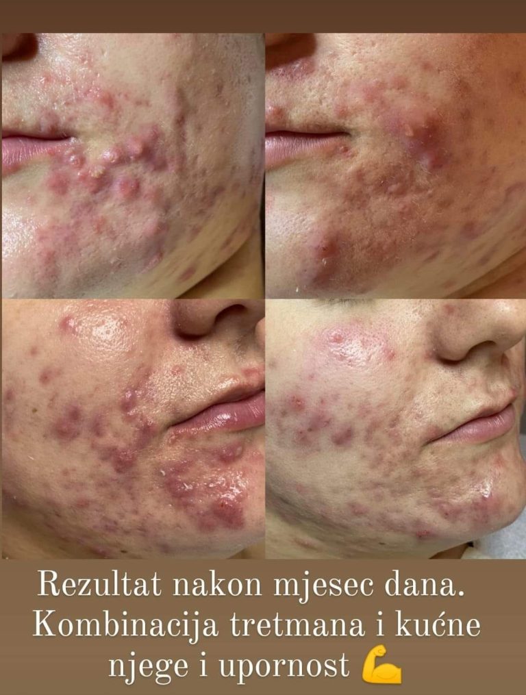 Što su akne?